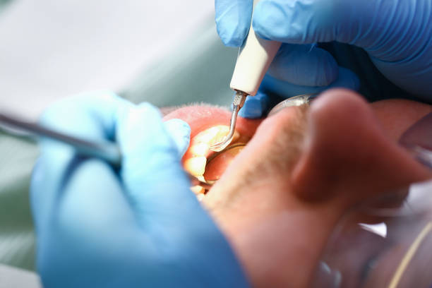 Best Emergency Dentist for Knocked-Out Tooth in Chenango Bridge, NY