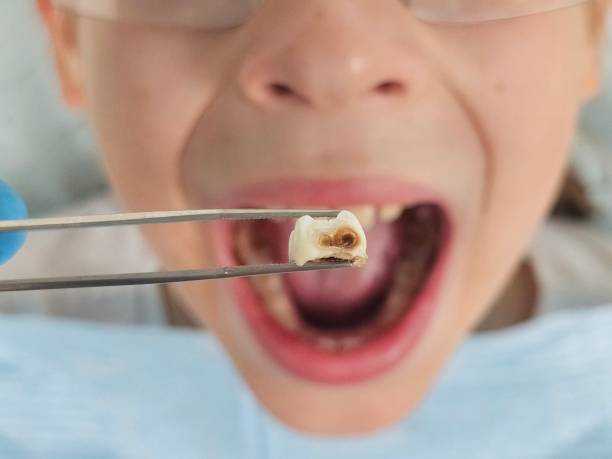 Best Emergency Dental Extractions in Chenango Bridge, NY